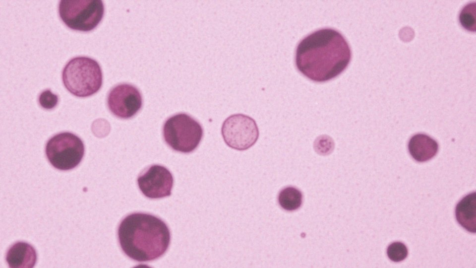 Czy niskie neutrofile są również związane z chorobami autoimmunologicznymi?